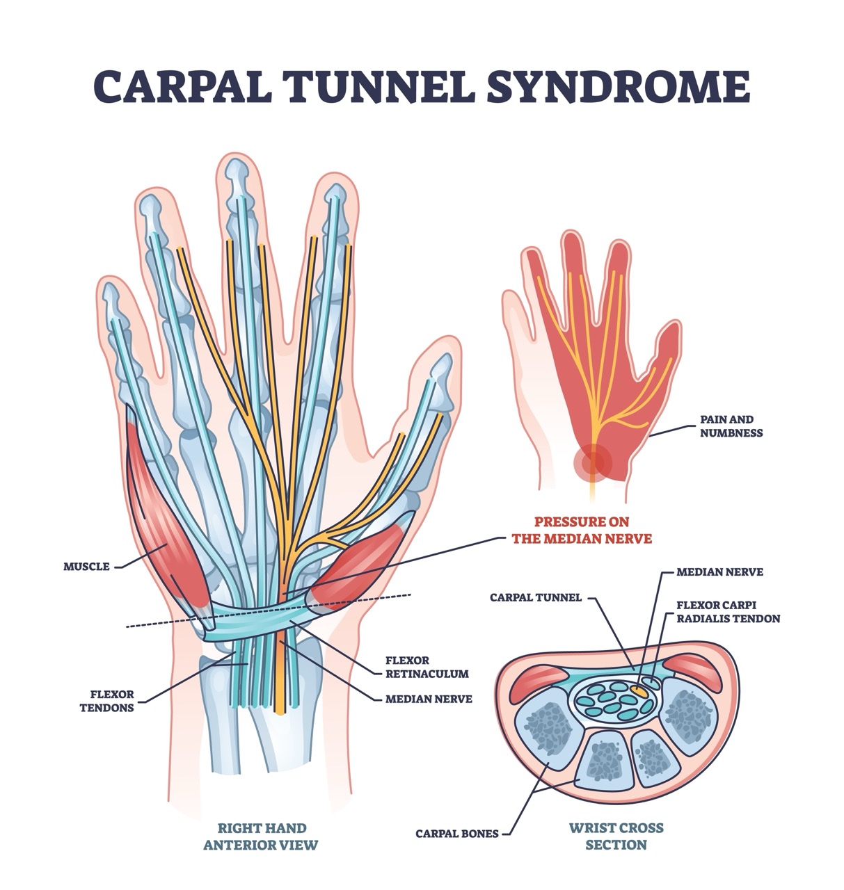 Illustration of carpal tunnel syndrome, with the parts of the hand and wrist identified.