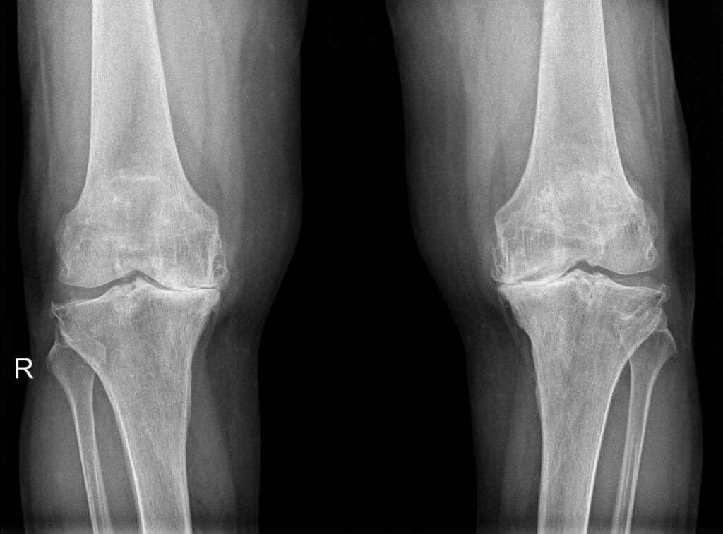 Advanced X-ray image of human knees.
