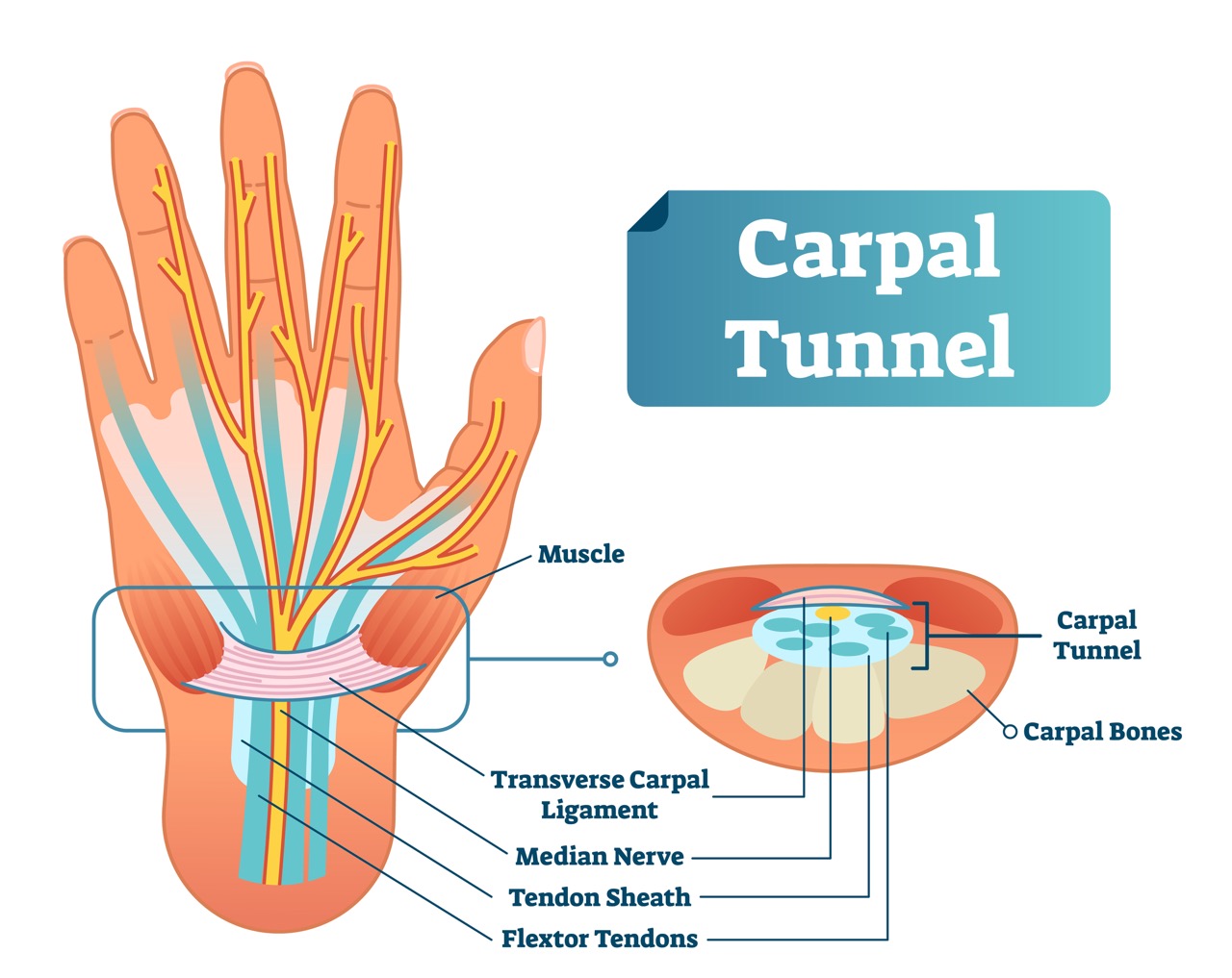 Anatomical image of a hand with carpal tunnel. 