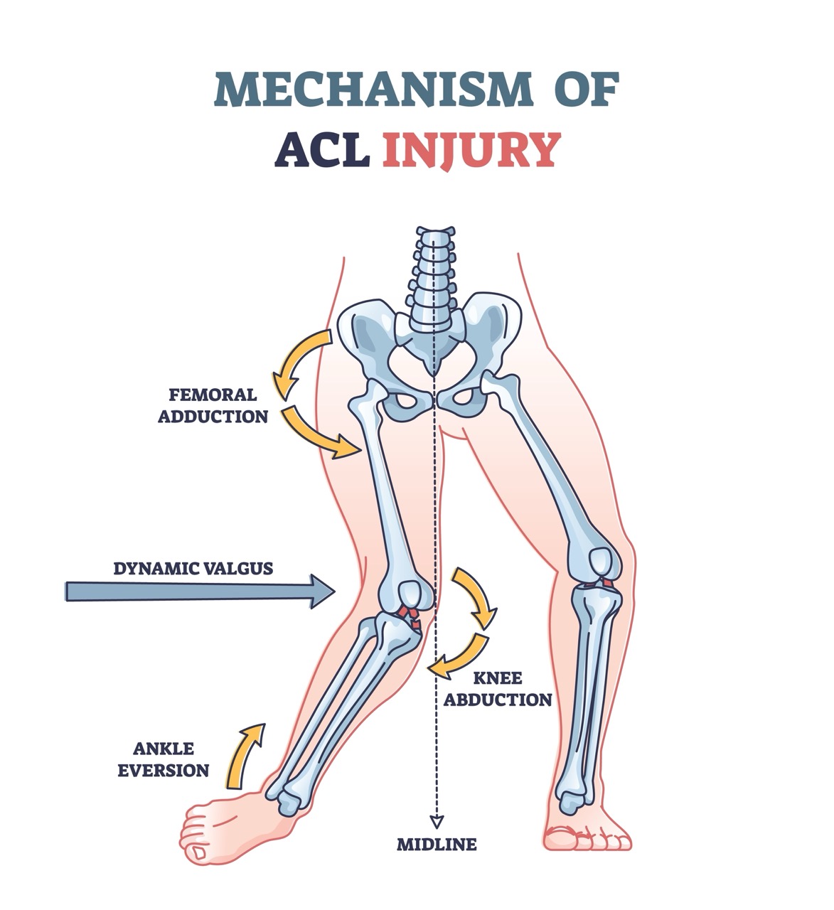 Mechanism of ACL injury as knee trauma anatomical explanation outline diagram. Labeled educational anterior cruciate ligament twist, abduction, ankle eversion and femoral adduction vector illustration