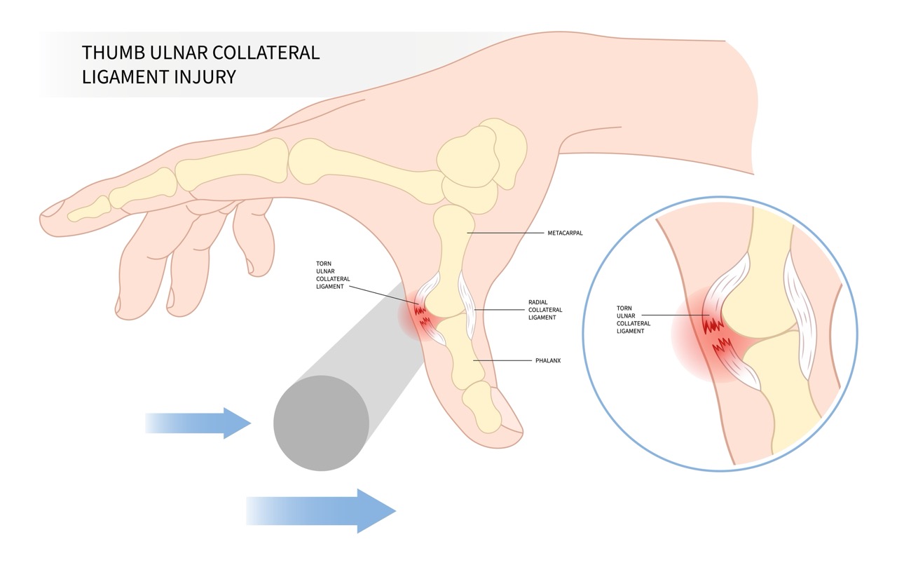 Gamekeeper's or Skier's and Bennett's finger thumb pain with wrist damage torn and fall dislocated onto an outstretched hand of Colles’ range of motion the sport accident first aid