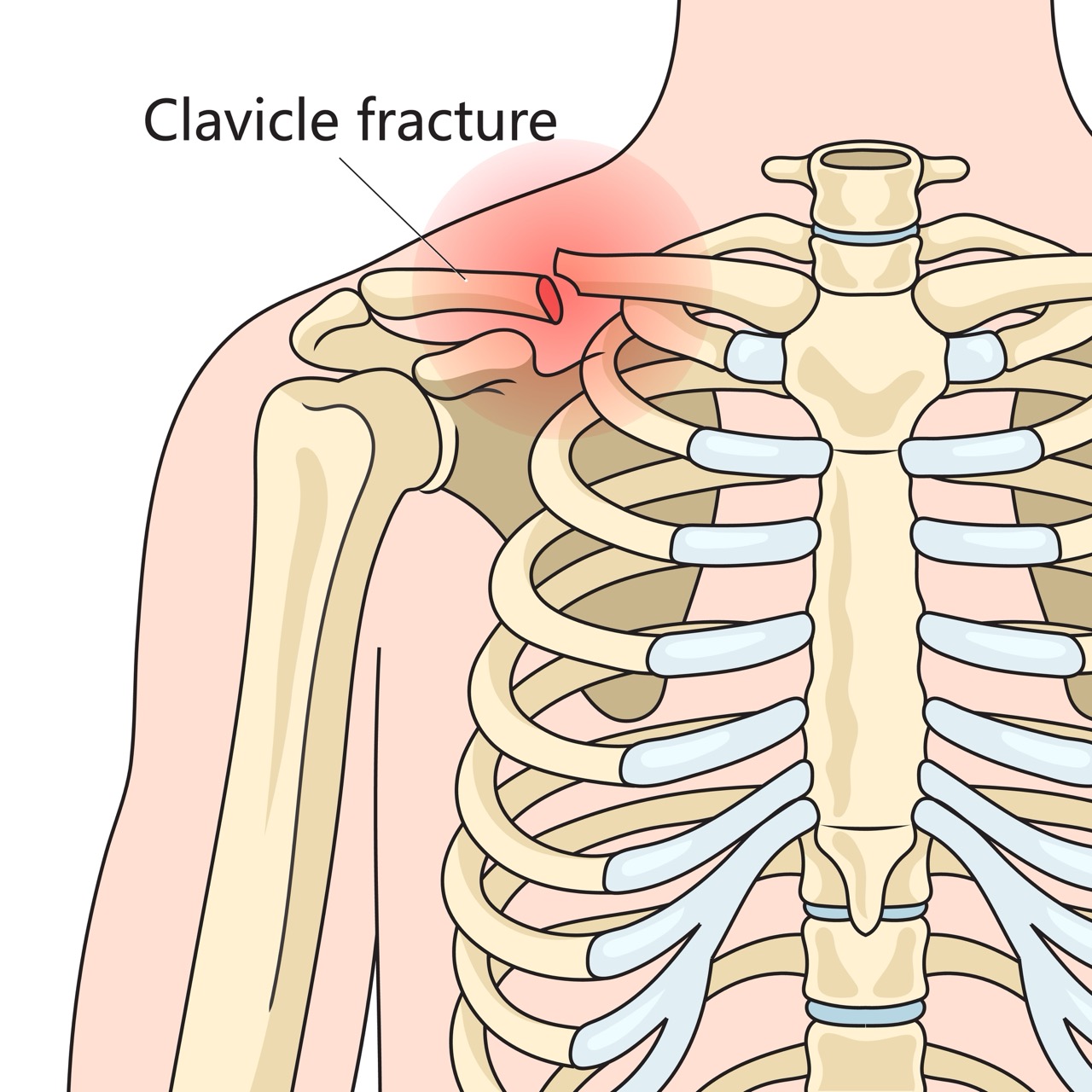 Clavicle fracture broken collarbone structure diagram schematic vector illustration. Medical science educational illustration